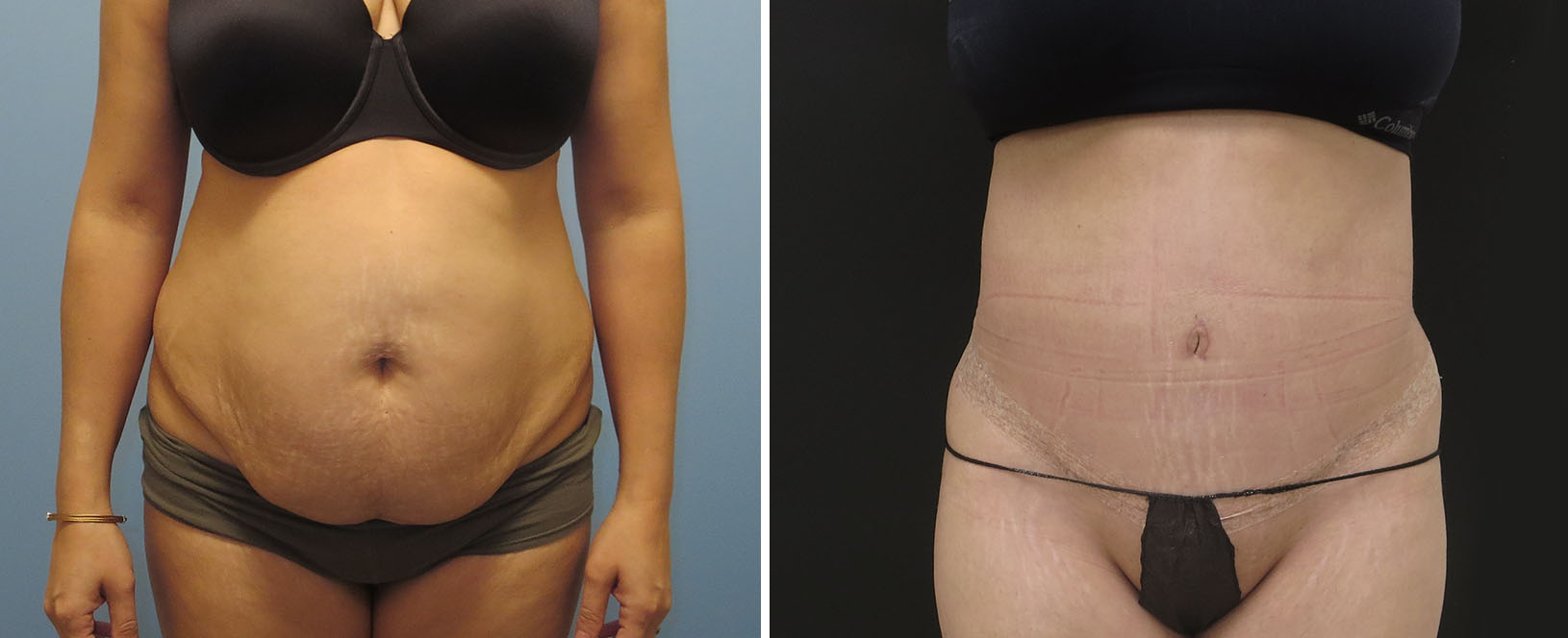 Tummy Tuck in Langley & Vancouver Metro, Plastic Surgeon, Dr. Mosher