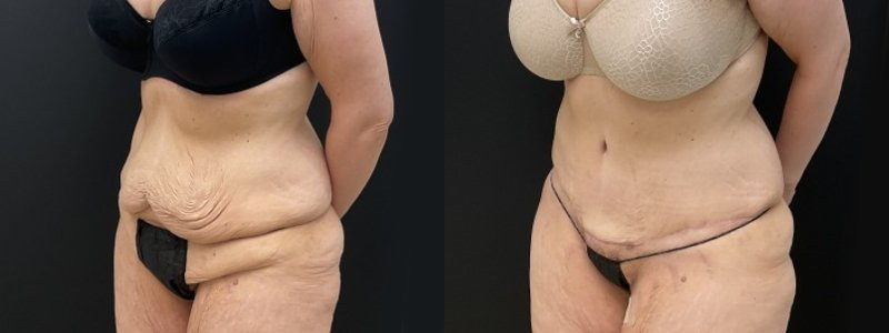 Tummy Tuck (3 Month Post op) Update!! Before and After In Pictures