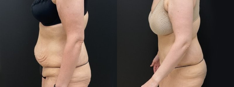 Abdominoplasty / Tummy Tuck Before and After Photos Vancouver, British  Columbia, CA