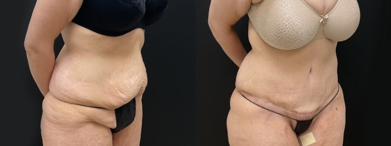 Mini Tuck And Tummy Tuck (abdominoplasty) Before & After Photos Patient 06