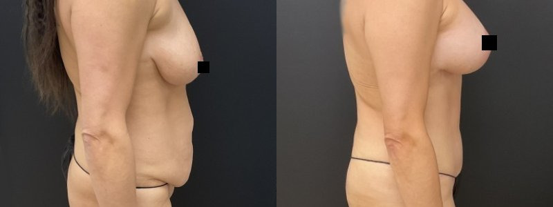 Chest Enhancement Surgery After Weight Loss